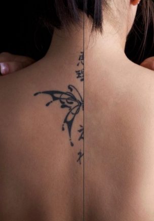 tatueringsborttagning